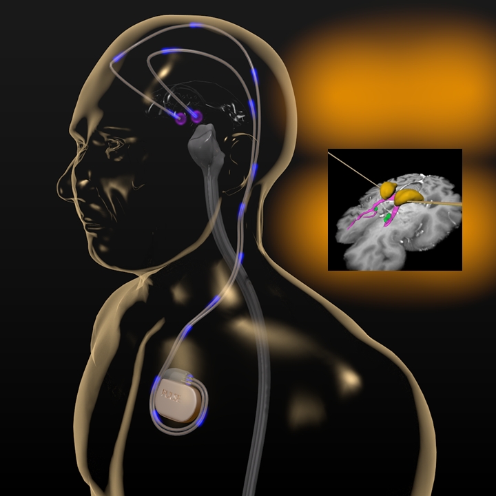 Diagram of a brain stimulator